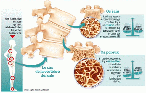 La hernie intervertébrale du service cervical que faire
